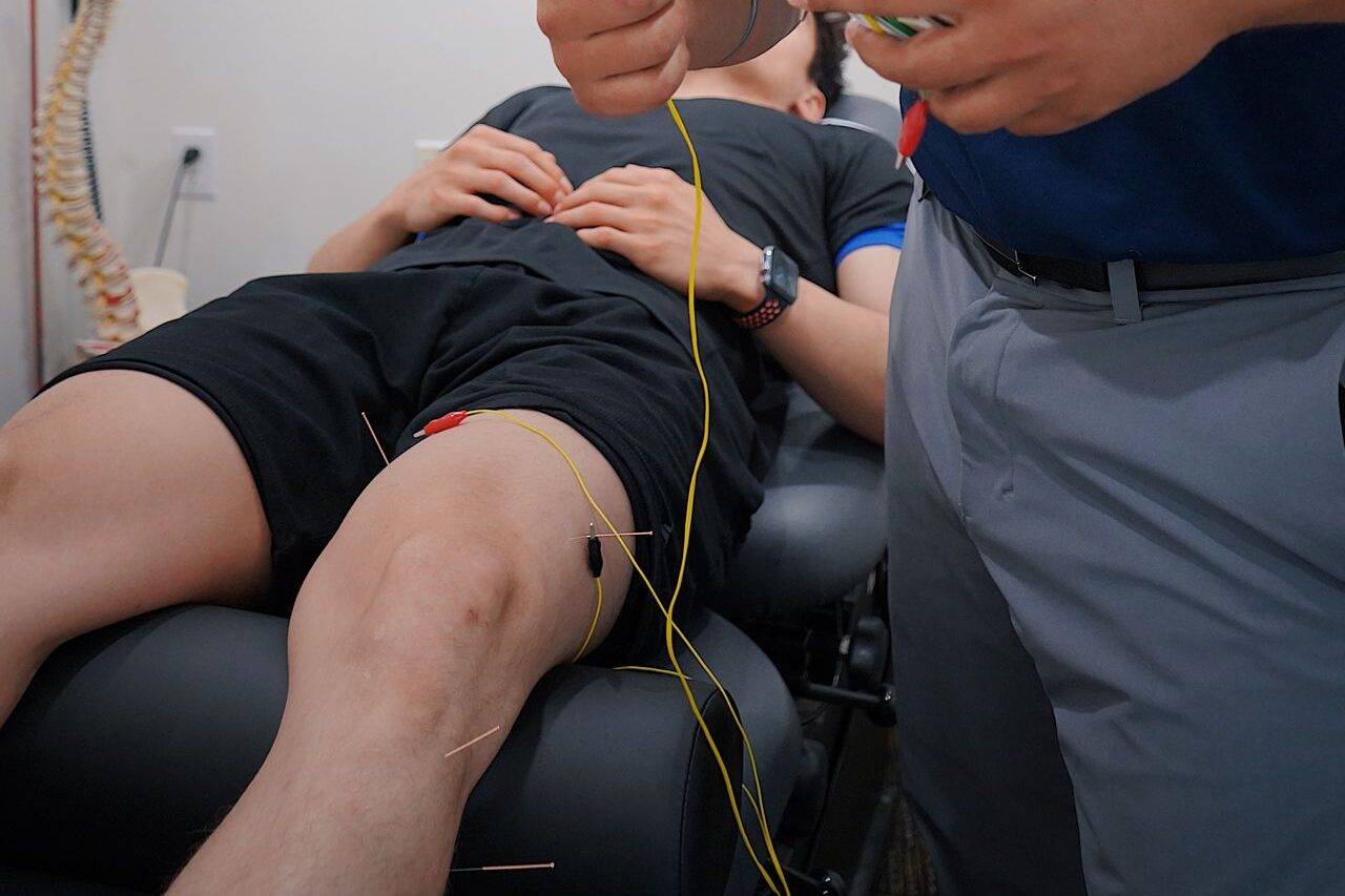 What Is Electroacupuncture? Benefits, Uses and What to Expect