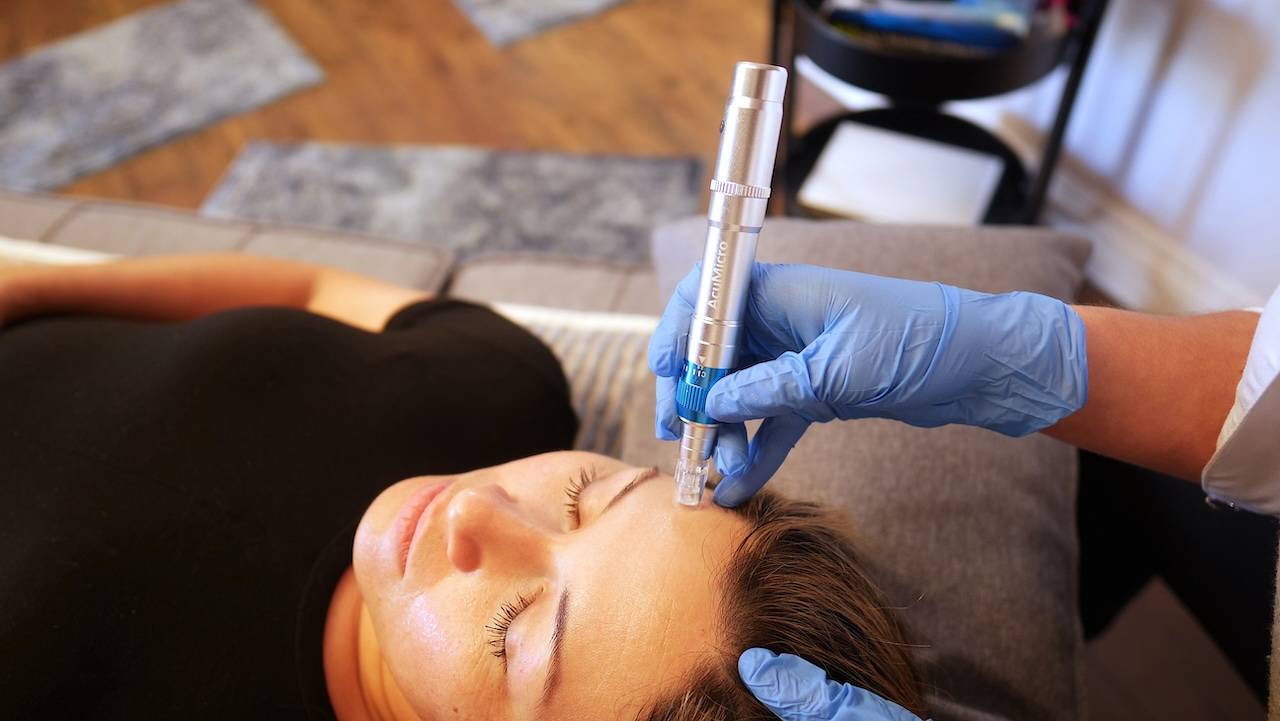 Microneedling Benefits, Uses and Recovery